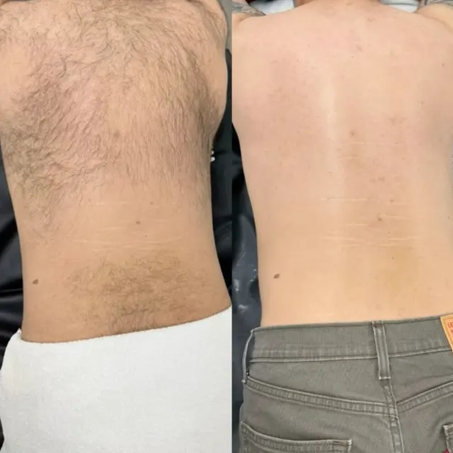 Laser hair removal before and after result