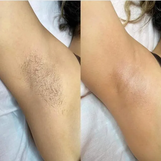 Laser hair removal before and after result