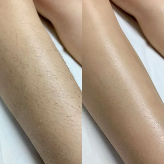 Laser hair removal before and after result