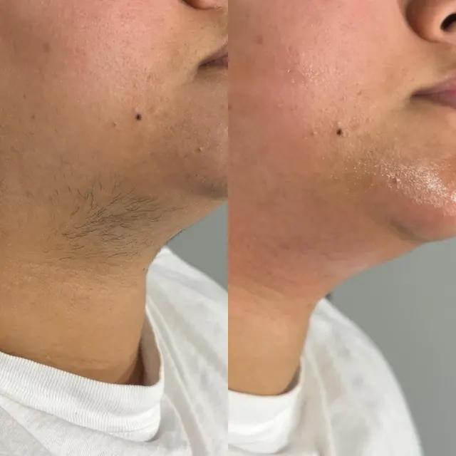 Laser hair removal before and after result