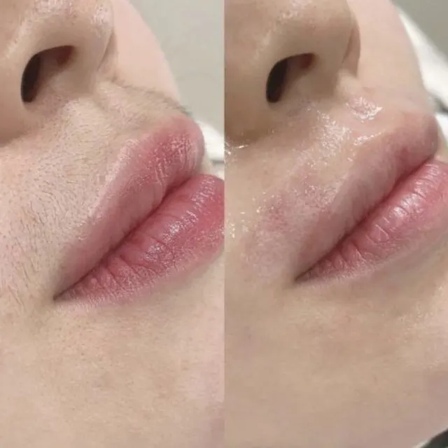 Laser hair removal before and after result