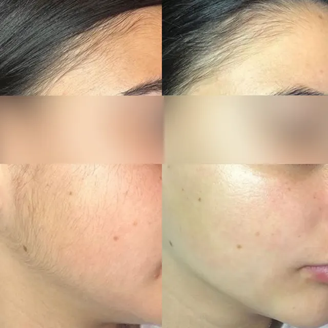 Laser hair removal before and after result