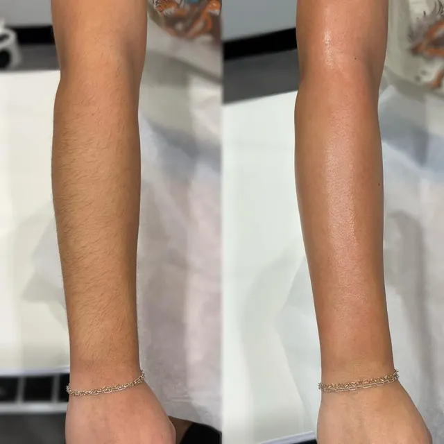 Laser hair removal before and after result