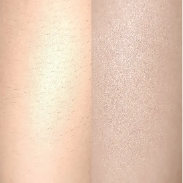 Laser hair removal patient result