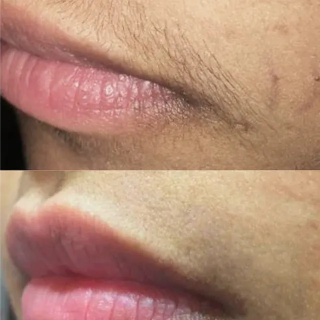 Laser hair removal result after sessions