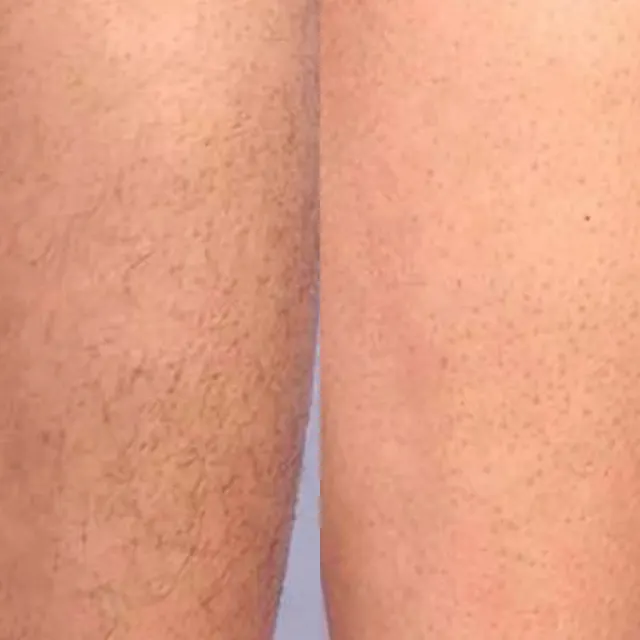 Laser hair removal result after sessions