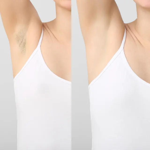 Laser hair removal result after sessions
