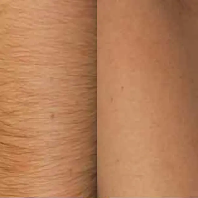 Laser hair removal result after sessions