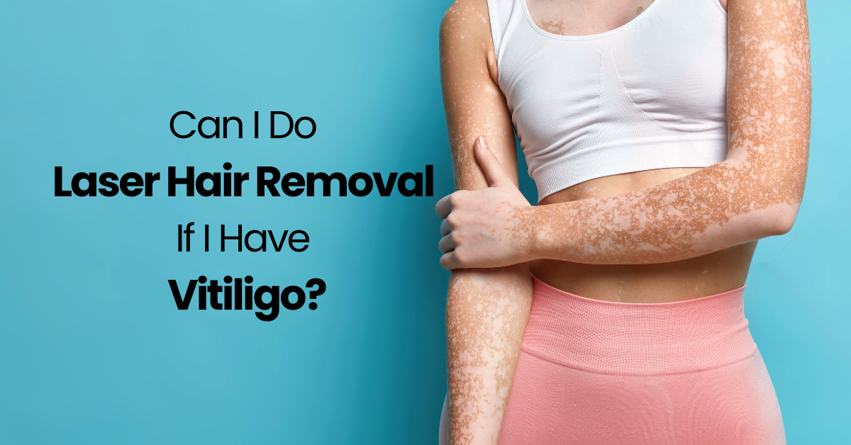 Can I Do Laser Hair Removal If I Have Vitiligo?