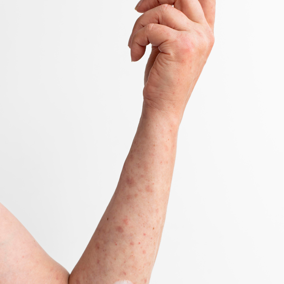 How to Remove Deep Chicken Pox Scars?