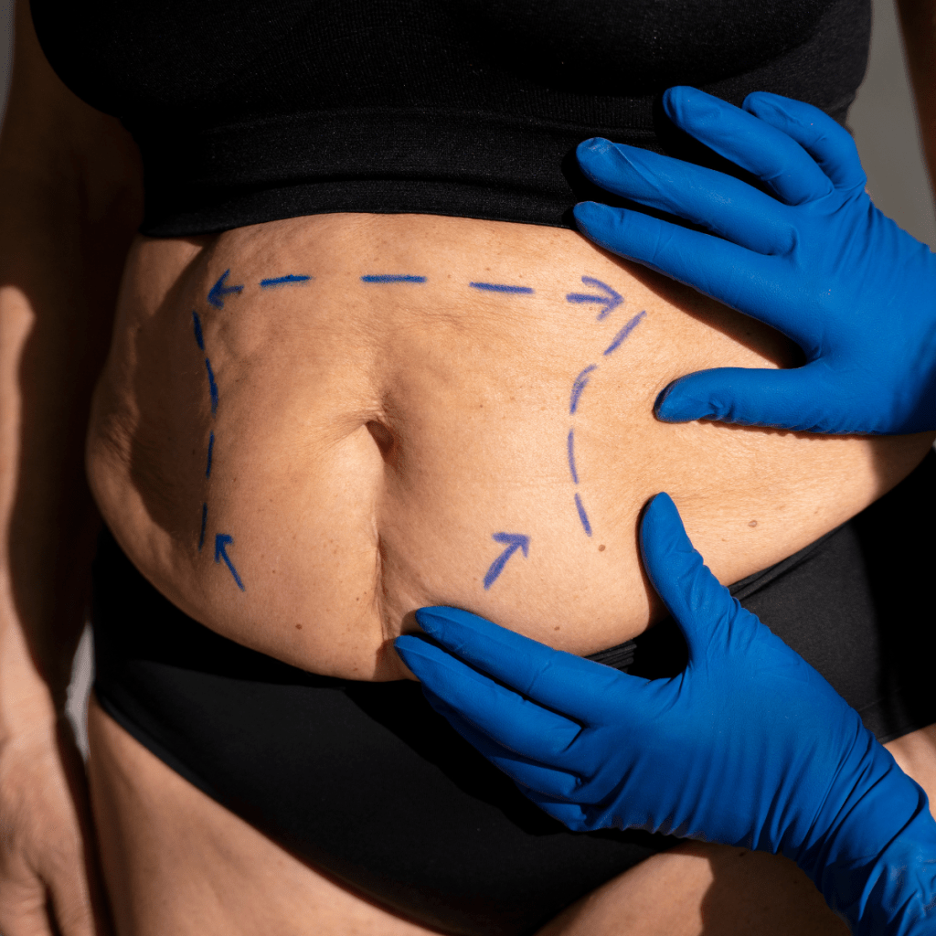Best Treatment for Post-Pregnancy Stretch marks