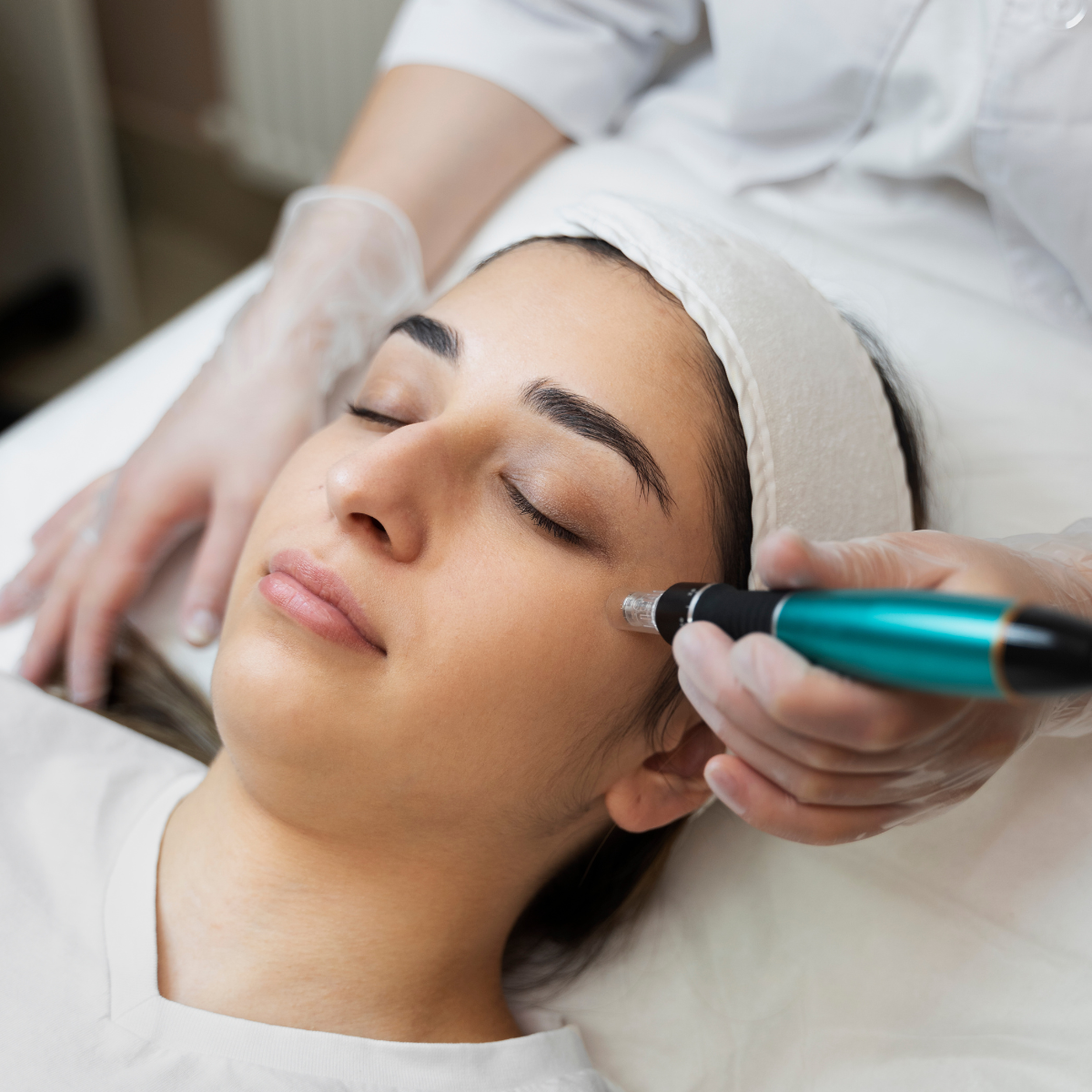My Experience with Microneedling Treatment