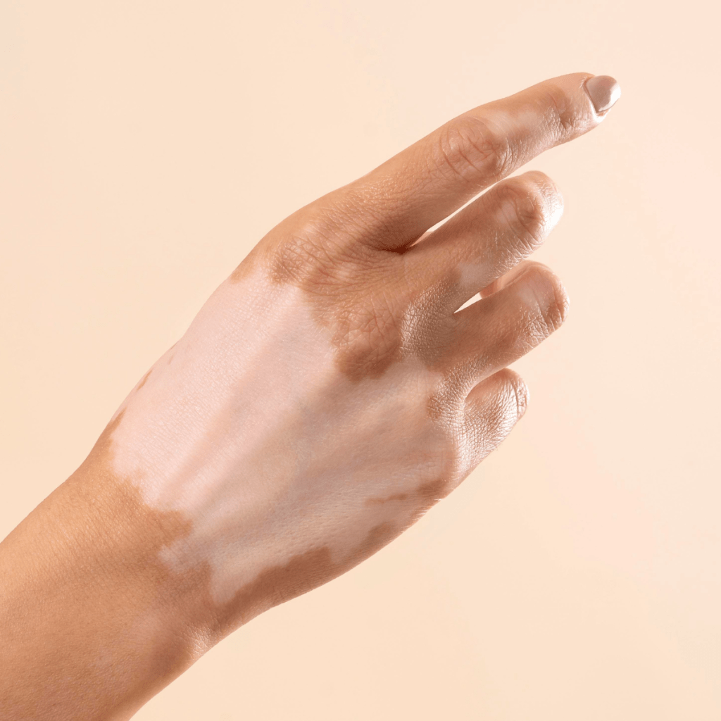 Vitiligo pigmentation cream