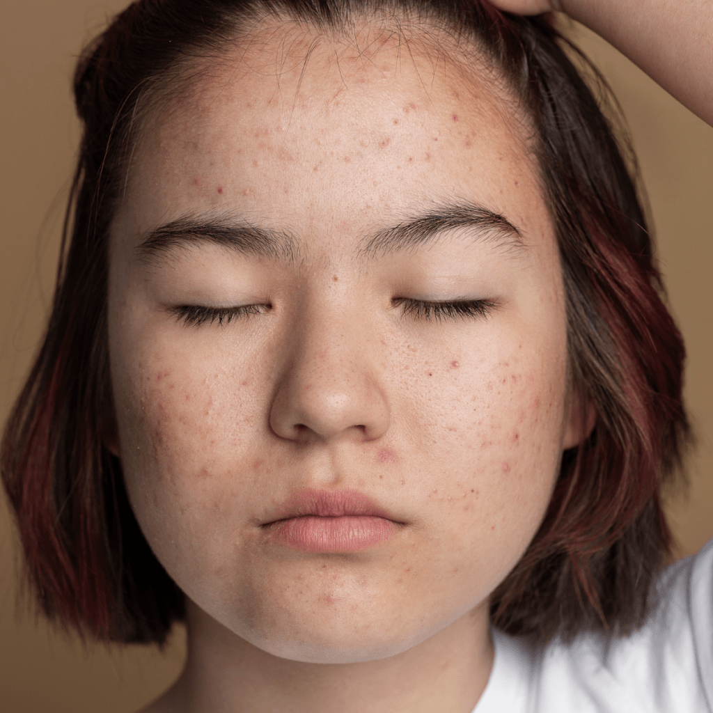 15 Effective and Safe Home Remedies for Acne